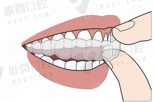 牙齿矫正是个坑（牙齿矫正被坑了一辈子）(图1)
